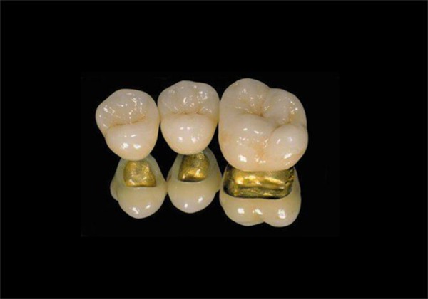 Gold Tooth Crown